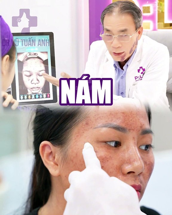 #225 CĐ Nám khi còn trẻ - 05.08 - 44 -H04