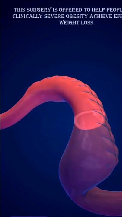 gastric bypass surgery جراحة تحويل مسار المعدة गैस्ट्रिक बाईपास सर्जरी Gastrik bypass ameliyatı.  Surgery for obesity