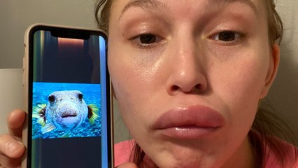 Mum has rare disease causing her face to swell "like a puffer fish"