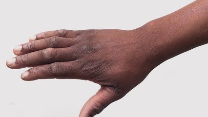 bd-manchas-en-la-piel-relacionadas-con-resistencia-a-la-insulina-070824