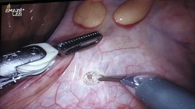 Improving the Quality of Life for Patients Using Robotic Arms