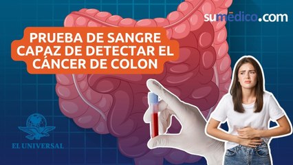 ¿En qué consiste la prueba de sangre capaz de detectar el cáncer de colon?