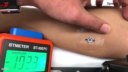 New Electric Bandage Speeds Wound Healing