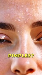 Simple tips to get rid of pimples