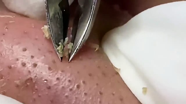 nose blackheads acne treatment