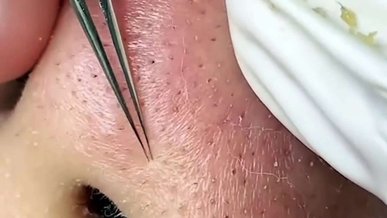 relax Satisfying nose blackheads treatment