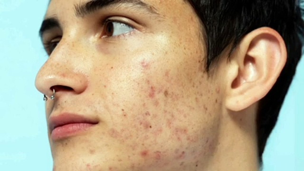 Acne treatment