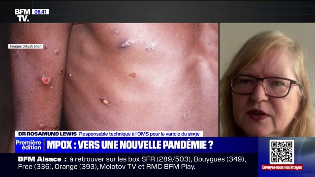 L'OMS déclenche son plus haut niveau d'alerte mondiale face à la résurgence des cas de variole du singe