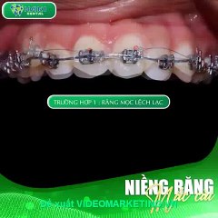 Quá trình niềng răng 1