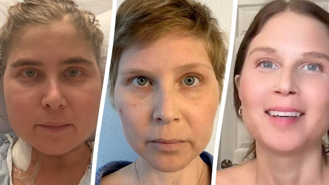 Woman mistook rare cancer for an allergic reaction when her face swelled