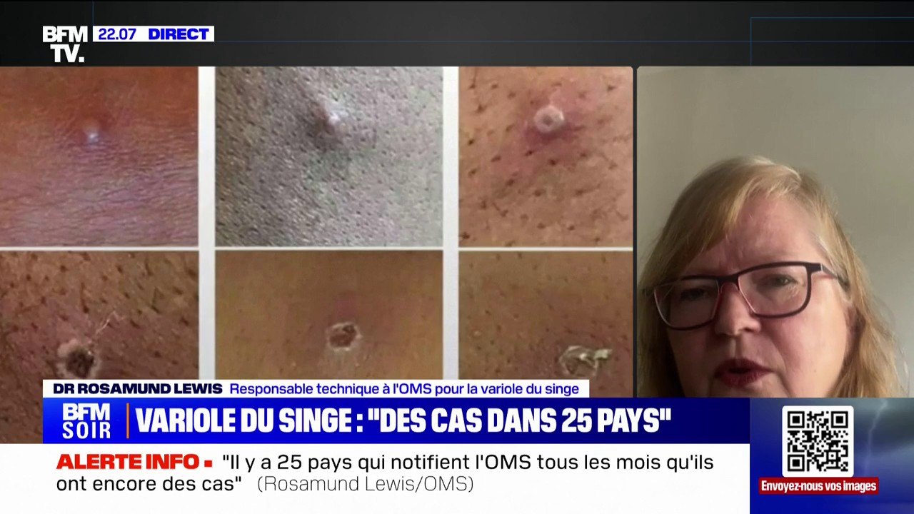 Rosamund Lewis (responsable technique à l'OMS pour la variole du singe): "Il y a des traitements spécifiques qui sont en cours d'investigation"