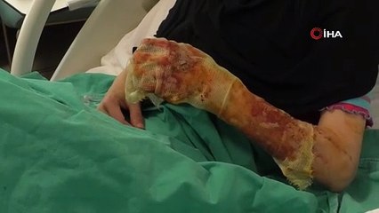 Mangal ateşine dezenfektan döken çift hastanelik oldu
