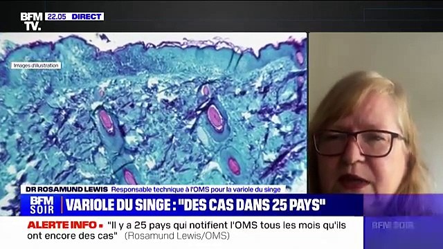 Variole du singe - Rosamund Lewis (responsable technique à l'OMS pour la variole du singe): Il y a des traitements spécifiques qui sont en cours d'investigation - Regardez