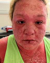 "My skin, hair and nails FELL OFF after I was bitten by a mosquito in Caribbean"