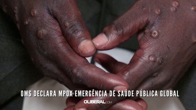 OMS declara mpox emergência de saúde pública global