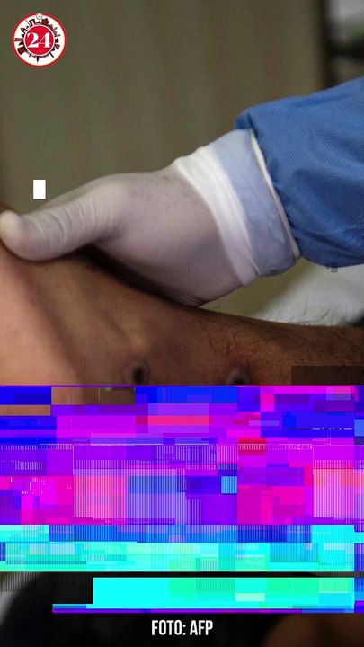 OMS emite alerta máxima por brote de viruela mpox