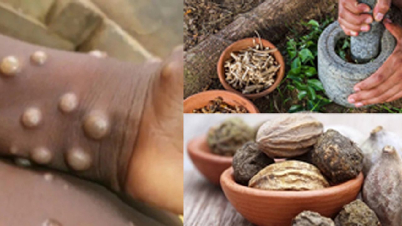 Monkeypox Kya Hota Hai, Symptoms & Treatment At...