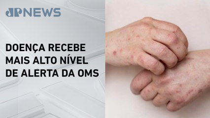 Suécia registra primeiro caso de variante da Mpox fora da África