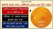 Eye Flashes Bangla: causes, signs, and treatment. #eyeflashes #eyeFloaters