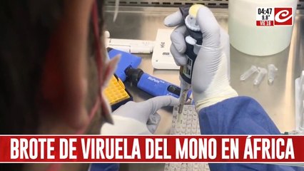 Preocupación mundial por brote de viruela del mono: ¿cómo se evita el contagio?