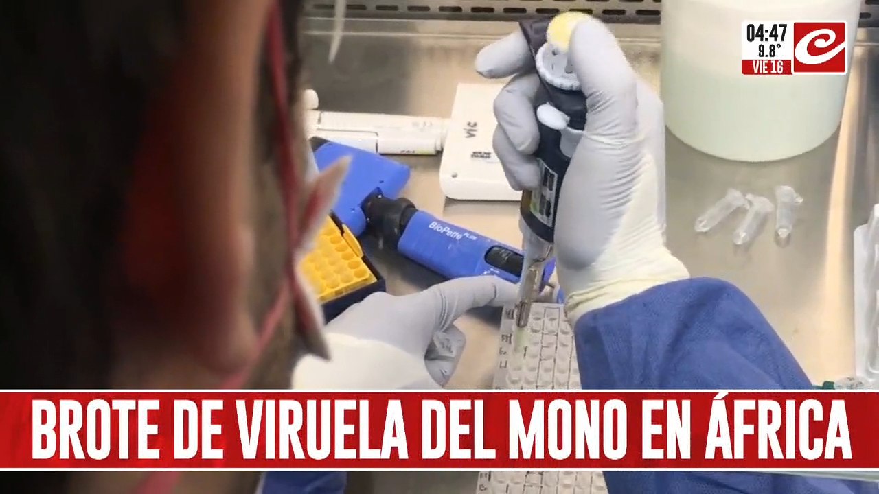 Preocupación mundial por brote de viruela del mono: ¿cómo se evita el contagio?