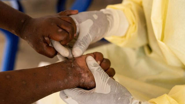 Variole du singe : le nouveau variant du mpox détecté pour la première fois en Suède