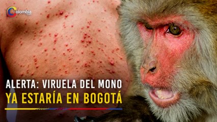 Viruela del mono estaría en Bogotá y otras dos zonas de Colombia, según el Instituto Nacional de Salud