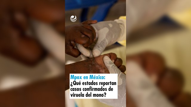 Mpox en México: ¿Qué estados ya reportan casos confirmados de viruela del mono?