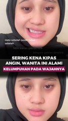 Sering Kena Kipas angin, Wanita ini Alami Kelumpuhan Pada Wajahnya