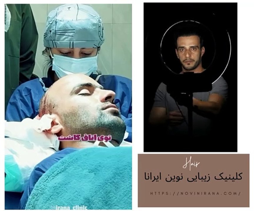 Hairtransplant