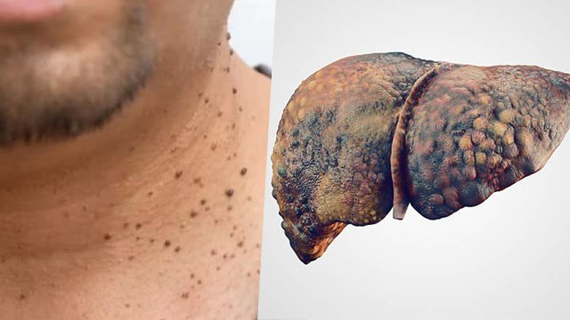 Gardan Par Masse Kyu Hote Hai | Neck Warts Early Signs Of Liver Disease Causes & Symptoms...