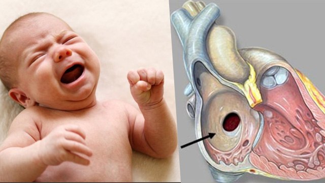 Newborn Baby Heart Hole Reason, Symptoms & Treatment: बच्चे के दिल में छेद का कारण, लक्षण और इलाज