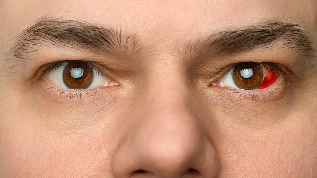 bd-prevencion-y-causas-de-los-derrames-oculares-200824