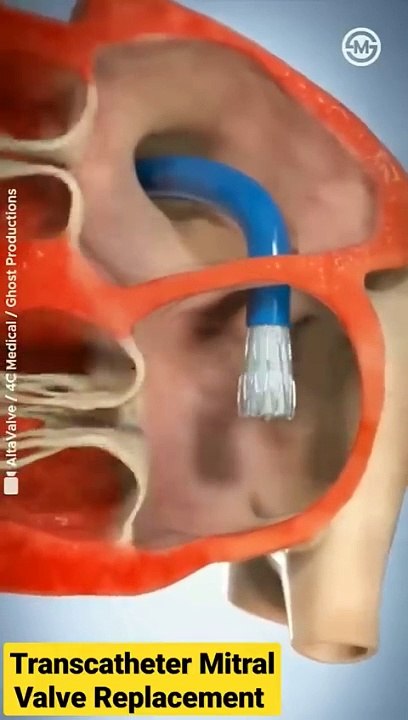Altavalve__Transcatheter_Mitral_Valve_Replacement__TMVR__#shorts_#medical_#animation
