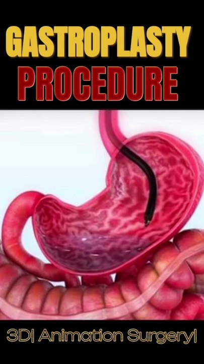 GASTROPLASTY|गैस्ट्रिक स्लीव सर्जरी एनीमेशन|weight Ioss surgery|#Viral#short#shortsfeed