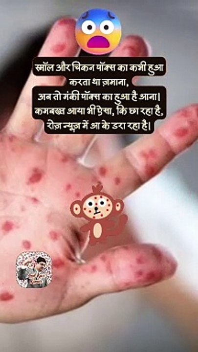 मंकी वाला पॉक्स   #shorts #shortsfeed #monkeypox #trending #AmitKaviKumar