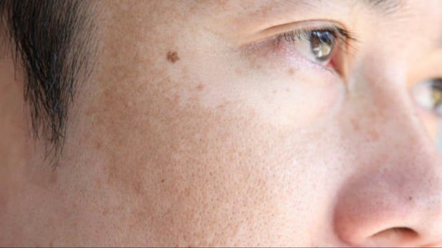 Melasma: Conoce Los Principales Síntomas Y Cómo Prevenirlo