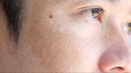 Melasma: Conoce Los Principales Síntomas Y Cómo Prevenirlo