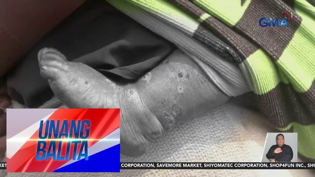 Pilipinas, naghayag ng intensyon sa W.H.O. na makakuha ng smallpox vaccine na ginagamit panlaban ng ilang bansa sa mpox | Unang Balita