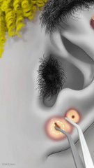 Colorfull Curls Beauty Ear small rings Remove | Cleanig eair-Pus treatment ASMR Animation #asmrvideo