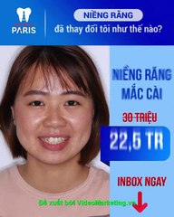 Nha khoa Paris báo giá niềng răng