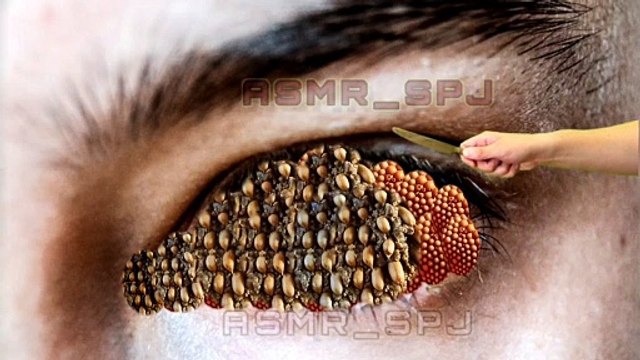 Relaxing ASMR Maggot and Tick Removal Eye Animation | Satisfying Asmr