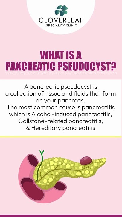 Pancreatic pseudocyst