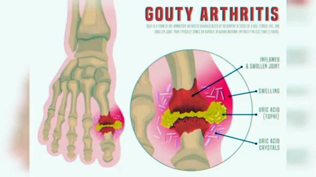 uric acid home remedy uric acid home remedy in hindi zindagi asaan یورک ایسڈ کا انوکھا گھریلو علاج uric acid remedy at home uric acid home remedies uric acid remedy home remedies for uric acid home remedies high uric acid remedy for uric acid uric