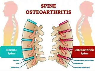 रीढ़ की हड्डी और उससे जुड़ी बीमारियां और समस्याएं | Backbone and disease associated with it in hindi