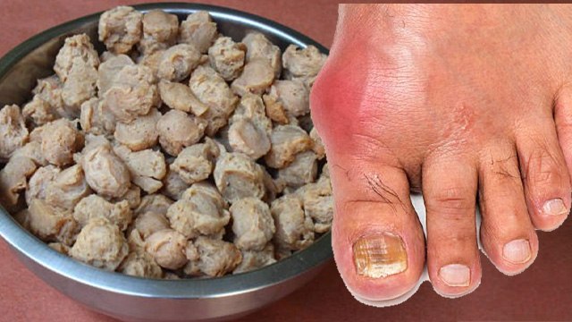 Food To Avoid In High Uric Acid: हाई यूरिक एसिड सबसे ज्यादा क्या खाने से बढ़ता है | Boldsky
