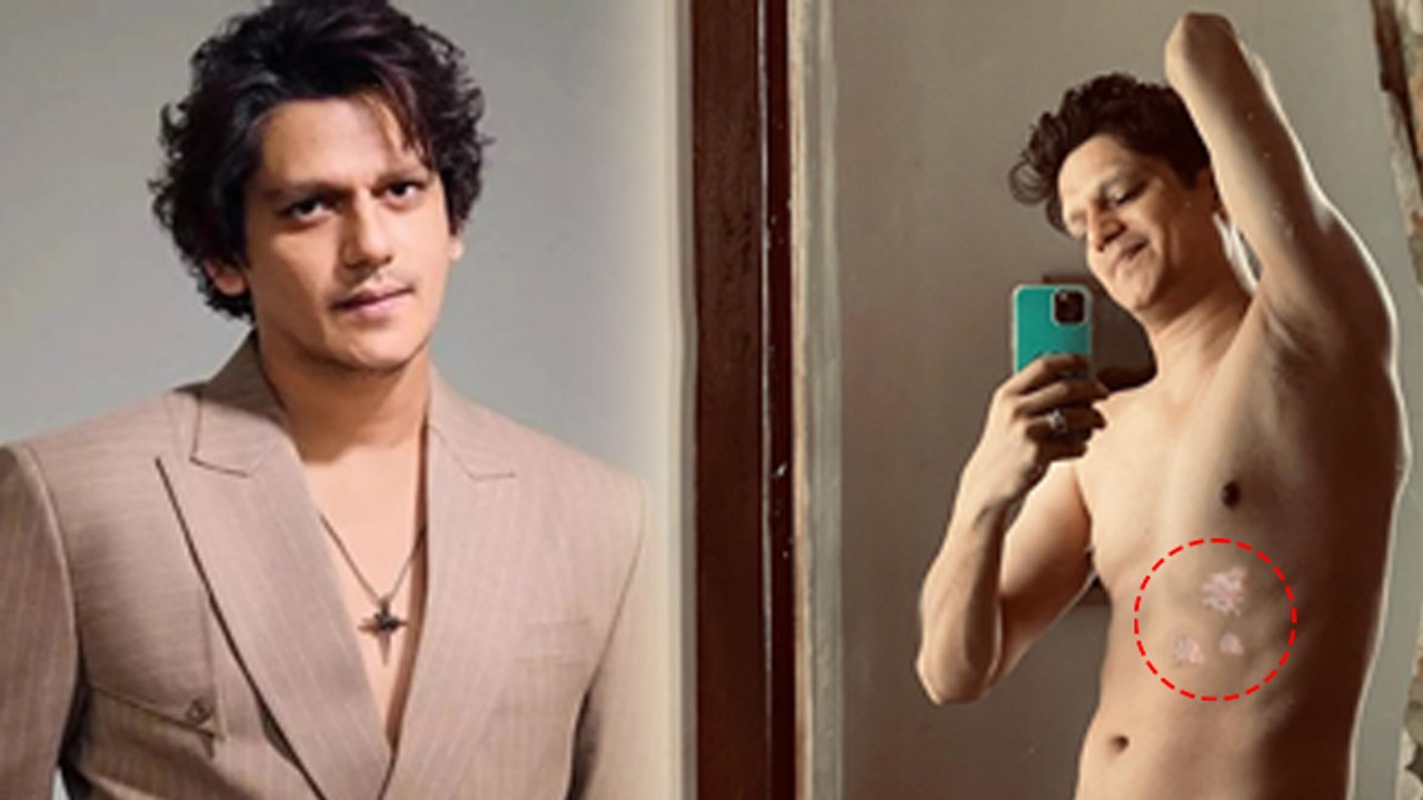 Vijay Varma Suffering From Vitiligo Skin Disease, Symptoms To Treatment...| Boldsky