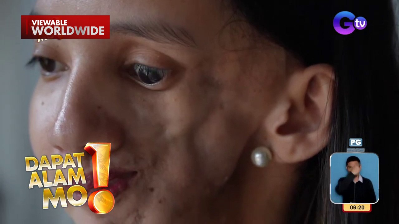 Dalagita, tampulan ng tukso noon dahil sa kanyang Parry Romberg Syndrome | Dapat Alam Mo!