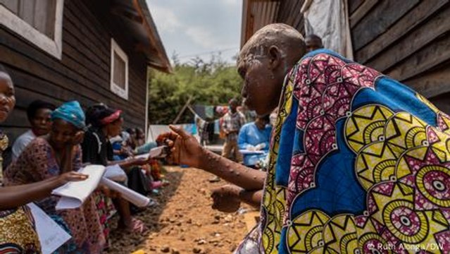 Mpox overwhelms Congo's South Kivu province