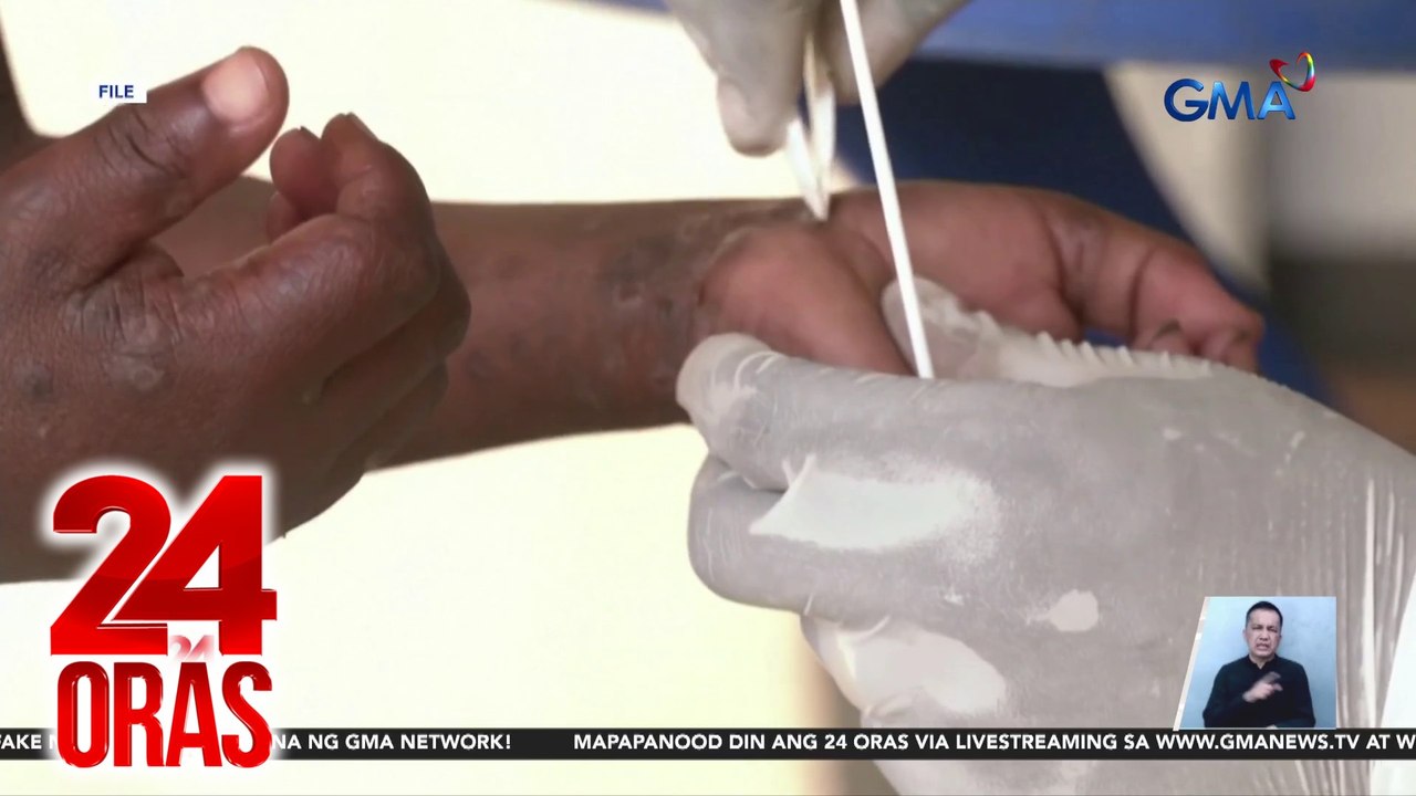 DOH, nilinaw na nakukuha ang mpox sa matagal na...